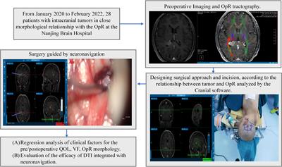 Applications of diffusion tensor imaging integrated with neuronavigation to prevent visual damage during tumor resection in the optic radiation area